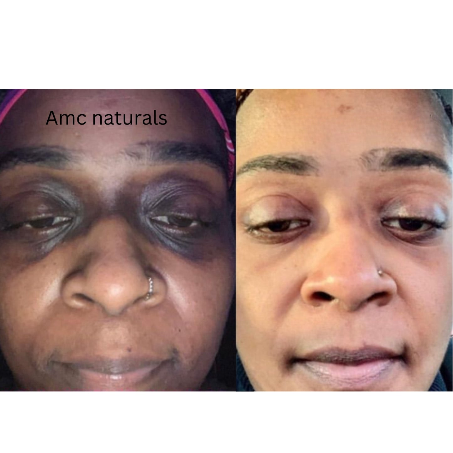 Dark Circles Serum, Under Eye Brightening Serum, Intense Dark Circle Eraser