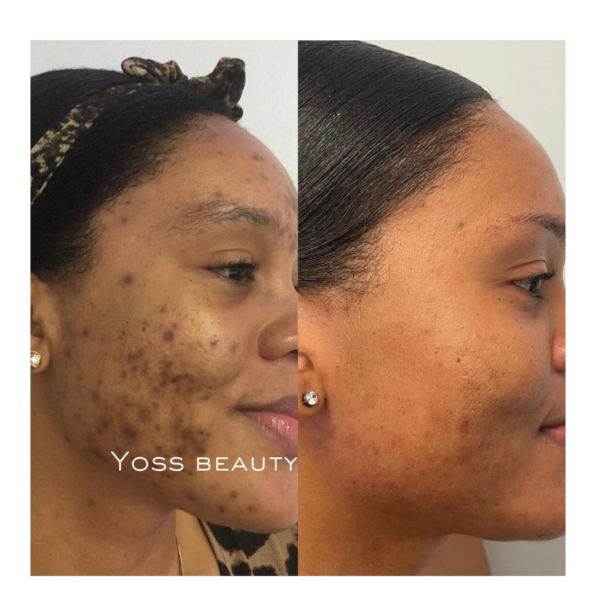 Turmeric Kojic Brightening Pads, Exfoliating Pads For Dark Spots, Blemish Pads, Glowing Skin Pads