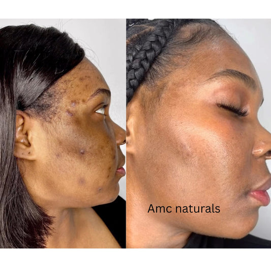 Turmeric Toner, Dark Spot Corrector, Blemish Remover, Even & Glowing Skin