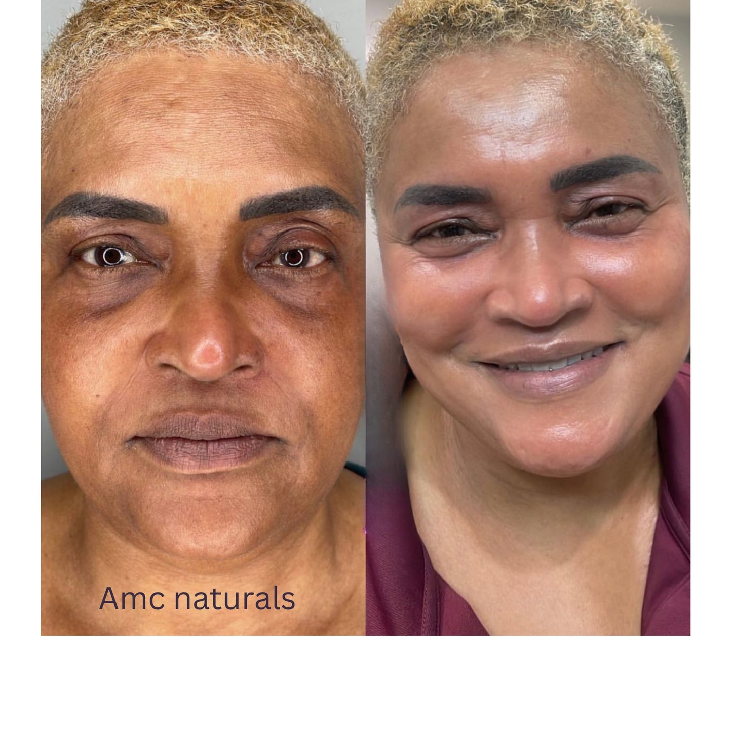 Dark Circles Serum, Under Eye Brightening Serum, Intense Dark Circle Eraser