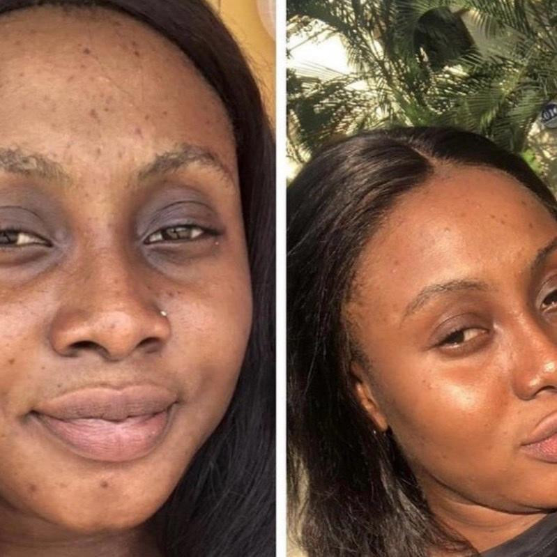 Dark Circles Serum, Under Eye Brightening Serum, Intense Dark Circle Eraser