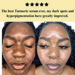 Turmeric Serum, Dark Spot Remover, Flawless Face Serum, Even Glowing Skin
