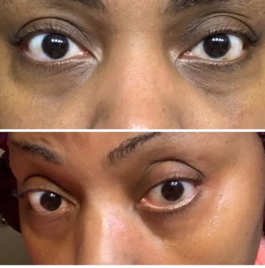 Dark Circles Serum, Under Eye Brightening Serum, Intense Dark Circle Eraser