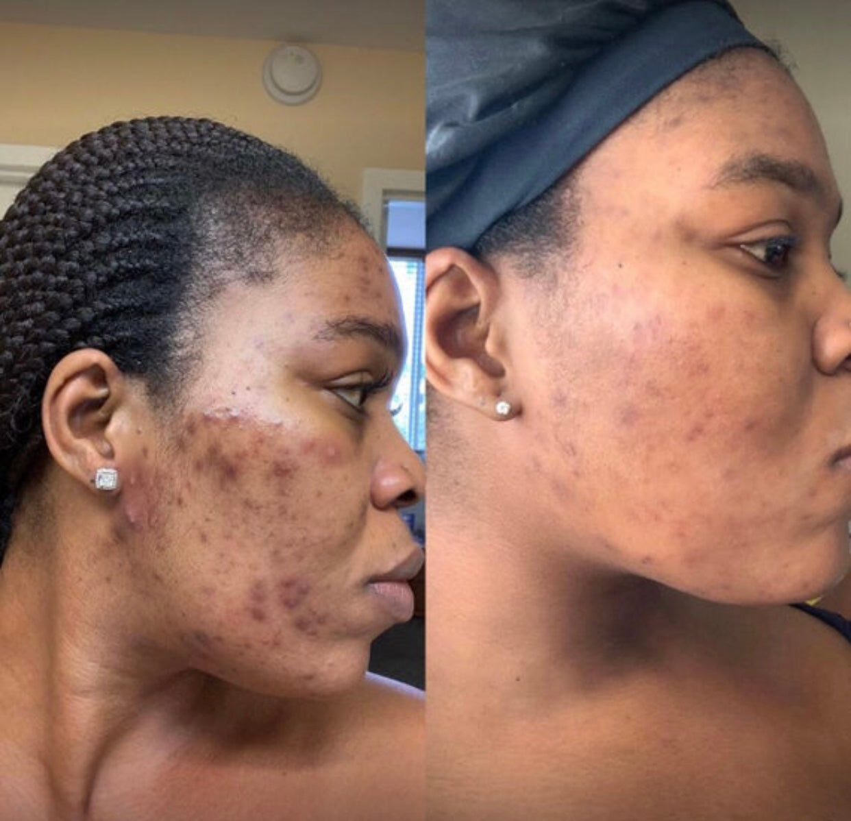 Turmeric Toner, Dark Spot Corrector, Blemish Remover, Even & Glowing Skin