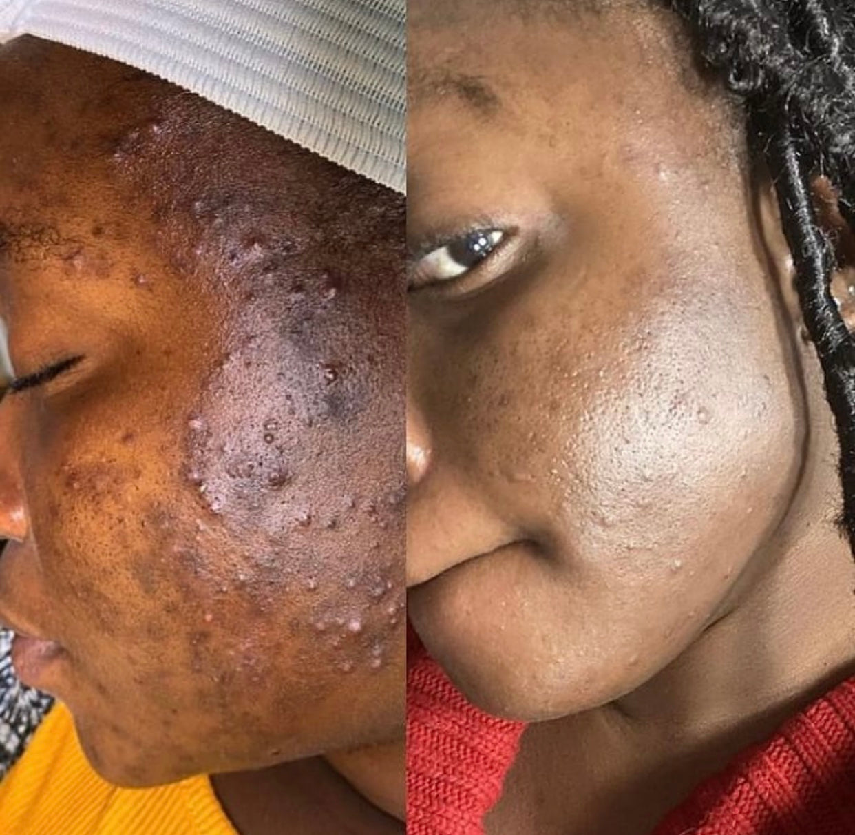 Turmeric Toner, Dark Spot Corrector, Blemish Remover, Even & Glowing Skin