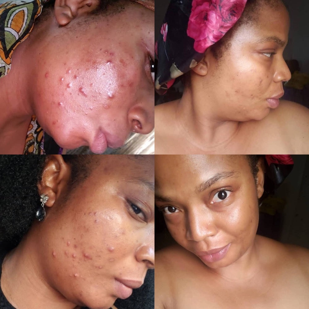 Turmeric Toner, Dark Spot Corrector, Blemish Remover, Even & Glowing Skin